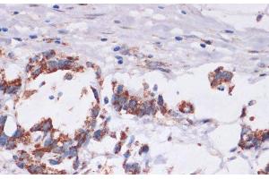 Immunohistochemistry of paraffin-embedded Human gastric cancer using DVL2 Polyclonal Antibody at dilution of 1:100 (40x lens). (DVL2 antibody)