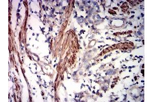 Immunohistochemical analysis of paraffin-embedded rectum cancer tissues using ACTA2 mouse mAb with DAB staining. (Smooth Muscle Actin antibody  (AA 2-124))