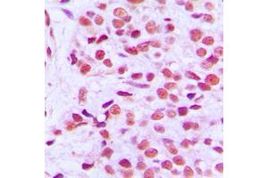 Immunohistochemical analysis of ETS1 (pT38) staining in human breast cancer formalin fixed paraffin embedded tissue section. (ETS1 antibody  (N-Term, pSer38))