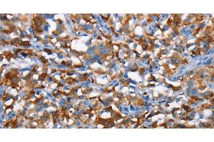 Immunohistochemistry of paraffin-embedded Human thyroid cancer tissue using CD226 Polyclonal Antibody at dilution 1:60 (CD226 antibody)