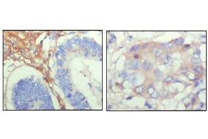 Immunohistochemical analysis of paraffin-embedded human colon cancer (left) and breast cancer (right) showing cytoplasmic localization with DAB staining using FBLN5 antibody. (Fibulin 5 antibody  (AA 242-448))