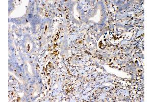 IHC analysis of Psoriasin using anti-Psoriasin antibody . (S100A7 antibody  (AA 2-101))
