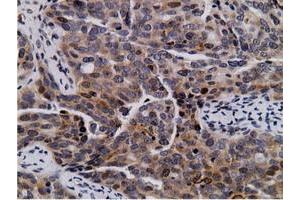 Immunohistochemical staining of paraffin-embedded Carcinoma of Human lung tissue using anti-NT5DC1 mouse monoclonal antibody. (NT5DC1 antibody)