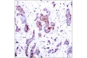 Immunohistochemistry analysis of paraffin-embedded human breast carcinoma tissue, using Rel (Ab-503) Antibody.