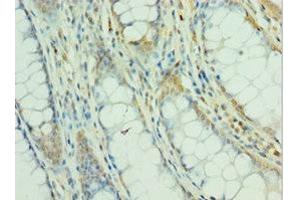 Immunohistochemistry of paraffin-embedded human colon cancer using ABIN7160504 at dilution of 1:100 (MEF2C antibody  (AA 170-380))