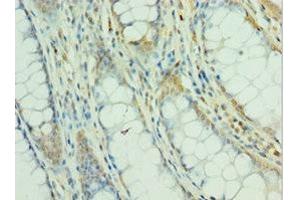 Immunohistochemistry of paraffin-embedded human colon cancer using ABIN7160504 at dilution of 1:100