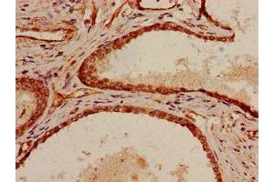 Immunohistochemistry of paraffin-embedded human prostate cancer using ABIN7169511 at dilution of 1:100 (SHC1 antibody  (AA 207-370))