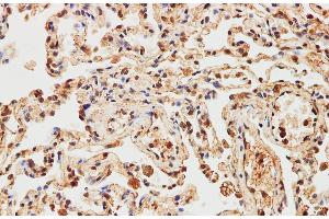 Immunohistochemistry of paraffin-embedded Human lung using IMP3 Polyclonal Antibody at dilution of 1:200 (IMP3 antibody)