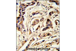 Formalin-fixed and paraffin-embedded human breast carcinoma reacted with TSHB Antibody , which was peroxidase-conjugated to the secondary antibody, followed by DAB staining. (TSHB antibody  (AA 58-86))