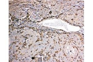 IHC-P: Gelsolin antibody testing of human lung cancer tissue. (Gelsolin antibody  (AA 763-775))