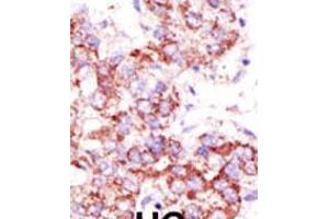 Formalin-fixed and paraffin-embedded human cancer tissue reacted with the primary antibody, which was peroxidase-conjugated to the secondary antibody, followed by AEC staining. (USP4 antibody  (C-Term))