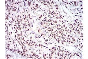 Immunohistochemical analysis of paraffin-embedded cervical cancer tissues using XRCC6 mouse mAb with DAB staining.