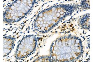 ABIN6261833 and ABIN6273246 at 1/100 staining Human colorectal cancer by IHC-P. (FXR1 antibody  (Internal Region))
