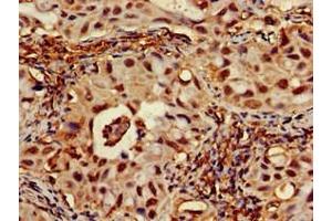 Immunohistochemistry of paraffin-embedded human lung cancer using ABIN7167701 at dilution of 1:100 (RPA1 antibody  (AA 2-616))