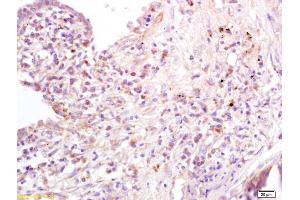 Formalin-fixed and paraffin embedded human lung carcinoma labeled with Anti-B7-1/CD80 Polyclonal Antibody, Unconjugated at 1:200 followed by conjugation to the secondary antibody and DAB staining