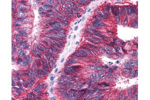 Anti-APLNR/ Apelin Receptor / APJ antibody IHC of human Colon, Carcinoma. (Apelin Receptor antibody  (Extracellular Domain))