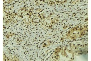ABIN6267182 at 1/100 staining Human breast cancer tissue by IHC-P. (SMAD1 antibody  (pSer206))