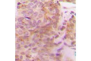 Immunohistochemical analysis of MLK2 staining in human breast cancer formalin fixed paraffin embedded tissue section. (MAP3K10 antibody  (Center))