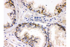 Anti- SAP97 Picoband antibody, IHC(P) IHC(P): Human Prostatic Cancer Tissue (DLG1 antibody  (AA 1-165))