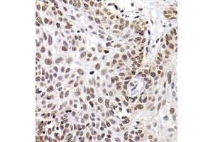Immunohistochemistry of paraffin-embedded human well-differentiated squamous skin carcinoma using PHIP antibody (ABIN6129078, ABIN6145556, ABIN6145557 and ABIN6223036) at dilution of 1:100 (40x lens).