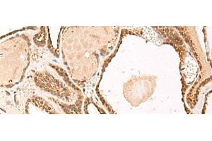 Immunohistochemistry of paraffin-embedded Human thyroid cancer tissue using FUNDC2 Polyclonal Antibody at dilution of 1:50(x200) (FUNDC2 antibody)