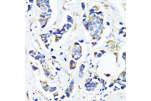 Immunohistochemistry of paraffin-embedded human breast cancer using MRPL45 antibody (ABIN6133218, ABIN6144020, ABIN6144021 and ABIN6217105) at dilution of 1:100 (40x lens).