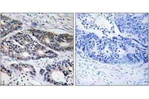 Immunohistochemistry analysis of paraffin-embedded human colon carcinoma, using Cytochrome P450 2R1 Antibody.