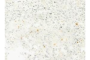 ABIN6263779 and ABIN6279623 at 1/100 staining human non-Hodgkin lymphoma by IHC-P. (NUP88 antibody  (Internal Region))