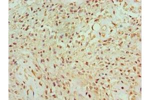 Immunohistochemistry of paraffin-embedded human breast cancer using ABIN7165122 at dilution of 1:100 (BANP antibody  (AA 1-260))