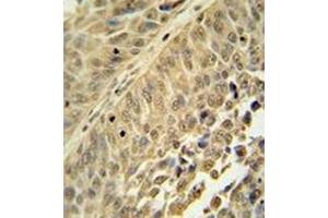 Immunohistochemistry analysis in formalin fixed and paraffin embedded human bladder carcinoma reacted with HNRNPC Antibody (C-term) followed by peroxidase conjugation of the secondary antibody and DAB staining.