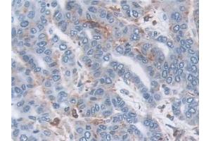 Detection of TPP1 in Human Liver cancer Tissue using Polyclonal Antibody to Tripeptidyl Peptidase I (TPP1)