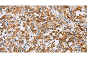 Immunohistochemistry of paraffin-embedded Human thyroid cancer tissue using BDH1 Polyclonal Antibody at dilution 1:60