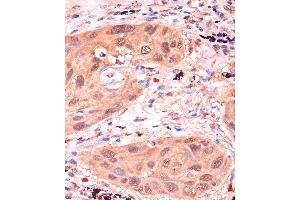 Immunohistochemistry of paraffin-embedded Human lung cancer using RPP38 Rabbit pAb (ABIN7269983) at dilution of 1:100 (40x lens). (RPP38 antibody  (AA 20-110))