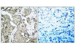 Immunohistochemical analysis of paraffin- embedded human breast carcinoma tissue, using MKK6 (phospho-Ser207) antibody (E011146). (MAP2K6 antibody  (pSer207))