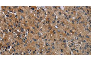 Immunohistochemistry of paraffin-embedded Human liver cancer using FAAH Polyclonal Antibody at dilution of 1:50 (FAAH antibody)