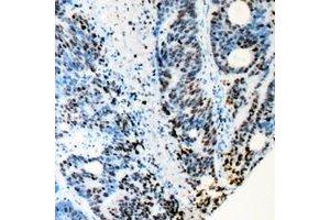 Immunohistochemical analysis of RB1 staining in human colon cancer formalin fixed paraffin embedded tissue section. (Retinoblastoma 1 antibody)