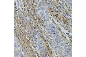 Immunohistochemistry of paraffin-embedded human esophageal cancer using COL1A1 antibody (ABIN5997480) at dilution of 1/100 (40x lens). (COL1A1 antibody)