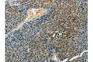 The image on the left is immunohistochemistry of paraffin-embedded Human liver cancer tissue using ABIN7190467(DGKB Antibody) at dilution 1/60, on the right is treated with synthetic peptide. (DGKB antibody)