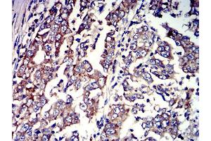 Immunohistochemical analysis of paraffin-embedded stomach cancer tissues using P2RY4 mouse mAb with DAB staining. (P2RY4 antibody)