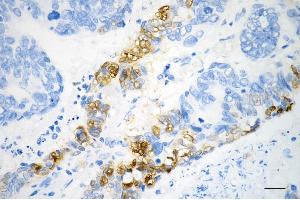 Immunohistochemistry was performed on paraffin-embedded human sigmoid colon carcinoma using phospho-NDRG1 (Ser330) antibody (ABIN7799537), 1:200).
