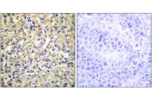 Immunohistochemistry analysis of paraffin-embedded human liver carcinoma tissue, using DUSP9 Antibody. (DUSP9 antibody  (AA 151-200))