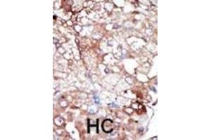 Formalin-fixed and paraffin-embedded human cancer tissue reacted with the primary antibody, which was peroxidase-conjugated to the secondary antibody, followed by DAB staining. (GAK antibody  (C-Term))