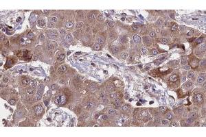ABIN6269031 at 1/100 staining Human liver cancer tissue by IHC-P.