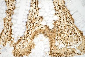 Immunohistochemistry was performed on paraffin-embedded human sigmoid colon carcinoma using histone H3 (mono methyl K9) antibody (ABIN7798962), 1:200).