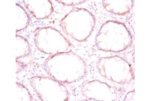 Immunohistochemistry of paraffin-embedded human colon cancer using ABIN7165284 at dilution of 1:50 (P4HB antibody  (AA 29-508))