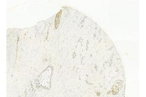 ABIN6262096 and ABIN6278471 at 1/100 staining human hepatocellular carcinoma by IHC-P. (GRO gamma antibody  (C-Term))
