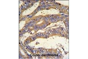 RSAD1 Antibody (C-term) (ABIN651455 and ABIN2840249) IHC analysis in formalin fixed and paraffin embedded human colon carcinoma followed by peroxidase conjugation of the secondary antibody and DAB staining. (RSAD1 antibody  (C-Term))