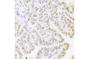 Immunohistochemistry of paraffin-embedded human thyroid cancer using HDGF Antibody.