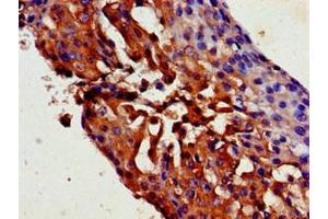 Immunohistochemistry of paraffin-embedded human breast cancer using ABIN7169527 at dilution of 1:100 (TRPC1 antibody  (AA 39-207))
