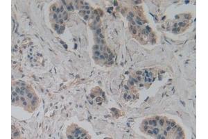 Detection of GAD2 in Human Breast cancer Tissue using Polyclonal Antibody to Glutamate Decarboxylase 2 (GAD2) (GAD65 antibody  (AA 65-105))